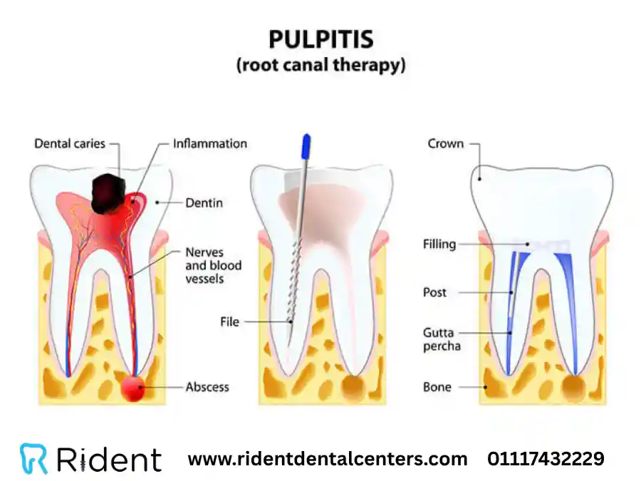 علاج حشو العصب في جلسة واحدة